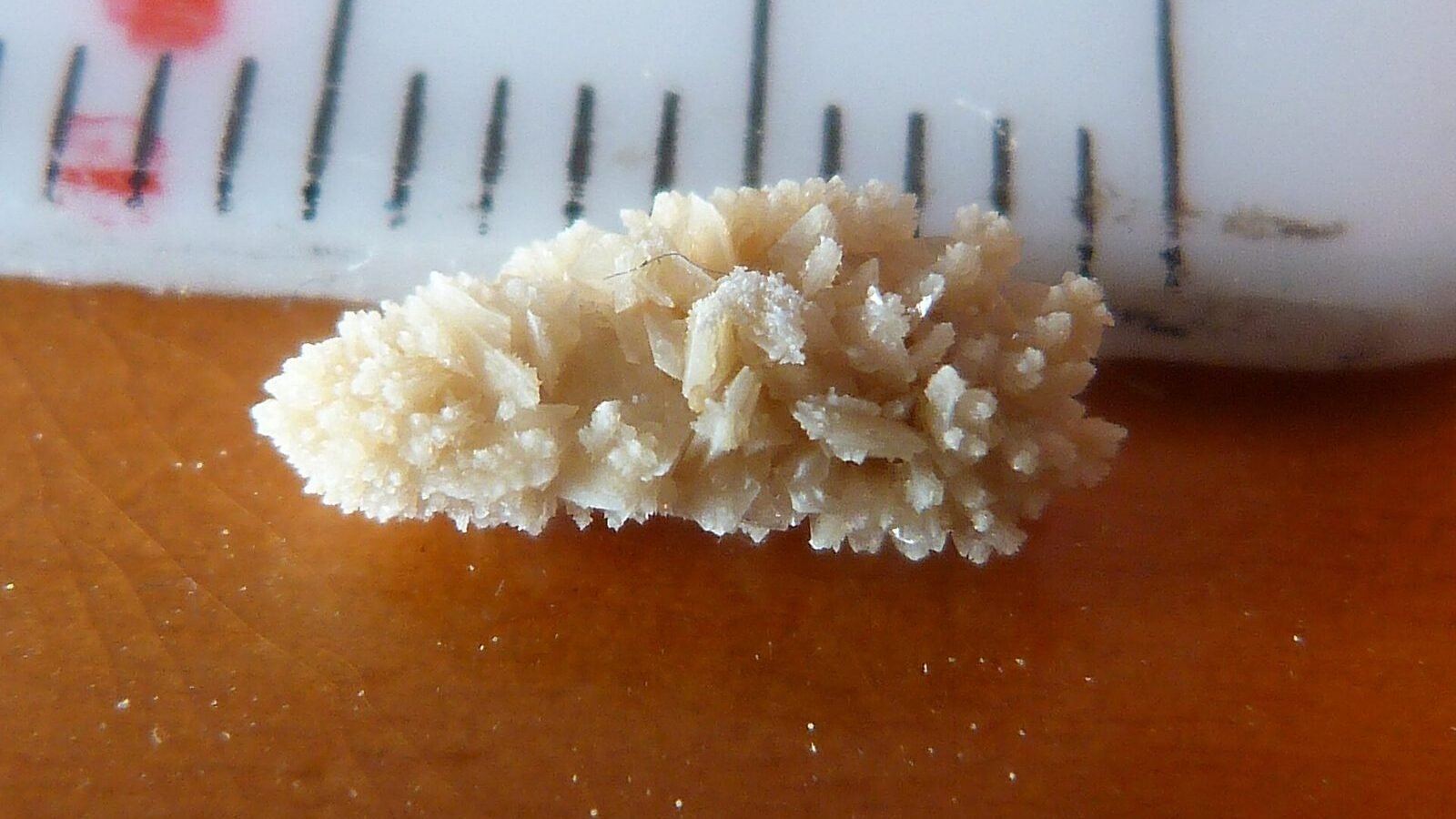 What Causes Kidney Stones?