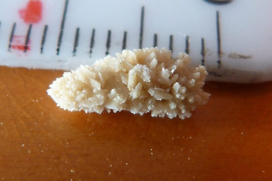 What Causes Kidney Stones?