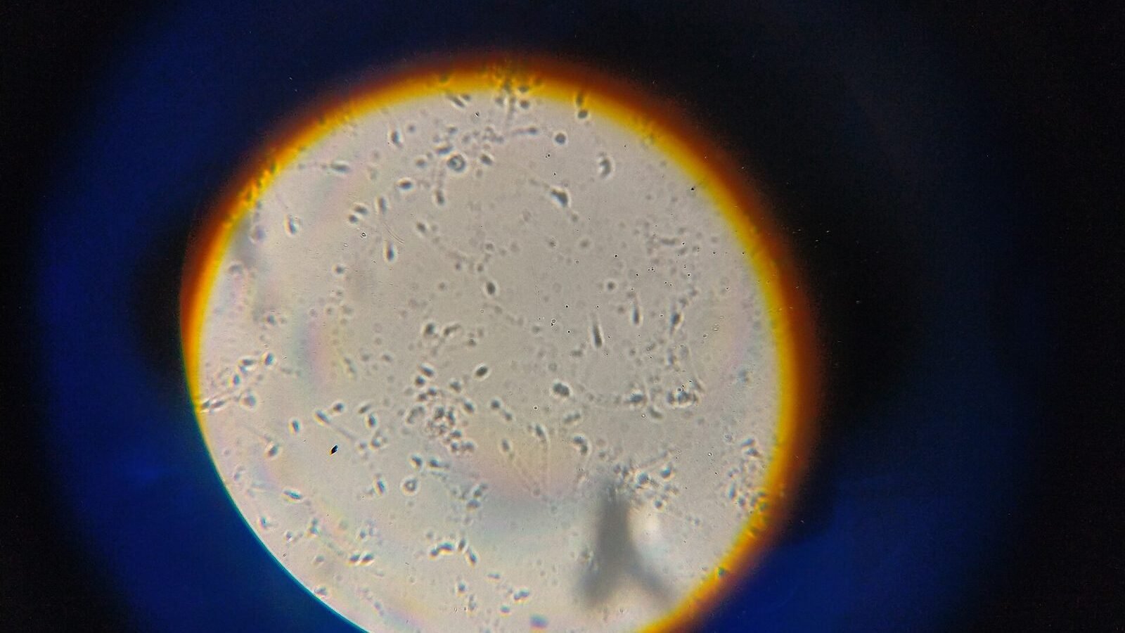 Male Infertility: Common Causes